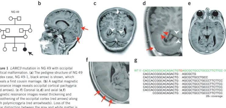 Figure 2  Additional LAMC3 mutations in individuals with occipital  cortical malformation