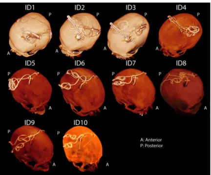 Fig 3. CT images of 10 patients operated for bilateral DBS implantation. For patients 1–4, the IPG was planned to be implanted in the left pectoral pocket