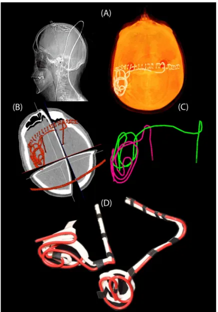 Fig 4. Steps of image segmentation (A-B), 3D model construction (C), and 3D printed plastic guides (D).
