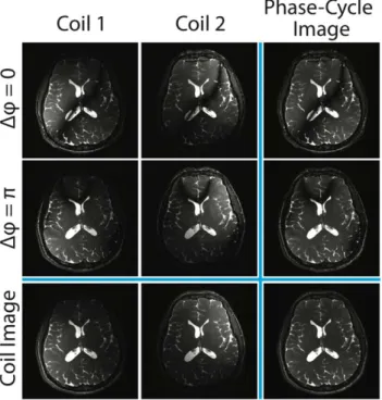 FIG. 1. Balanced SSFP images from two phase-cycled acquisi- acquisi-tions and two coils are shown