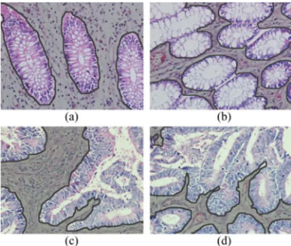 Fig. 2. Histopathological images of colon tissues: (a), (b) Normal and (c)-(d) cancerous