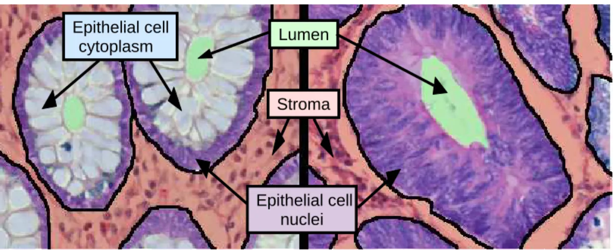 Figure 1.1: Cytological components in normal and cancerous colon tissues. Dif- Dif-ferent components are illustrated with difDif-ferent colors: green for luminal regions, red for stromal regions, purple for epithelial cell nuclei, and blue for epithelial c