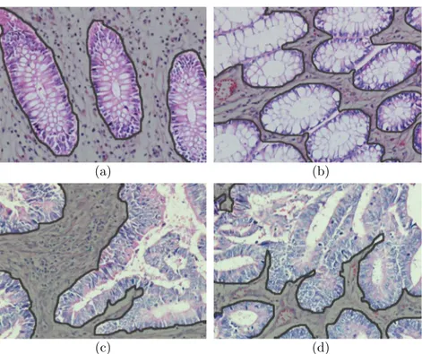 Figure 1.2: Histopathological images of colon tissues: (a)-(b) normal and (c)-(d) cancerous