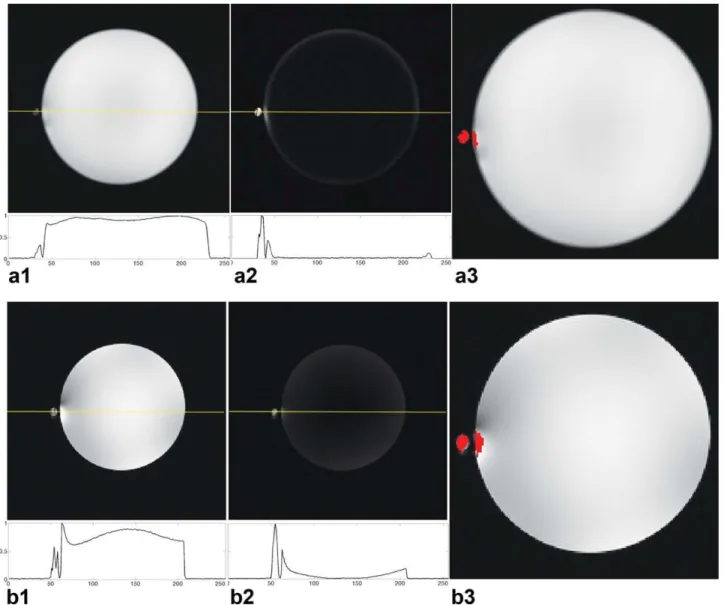 Figure 8 shows sagittal images of a saline solution phan- phan-tom with an ICRF coil attached to the phanphan-tom (Fig