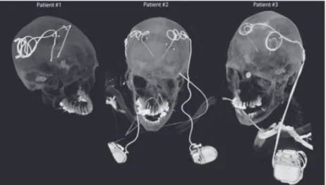 FIGURE 1  Postoperative CT images  of patients with isolated and fully implanted  DBS systems used in simulations