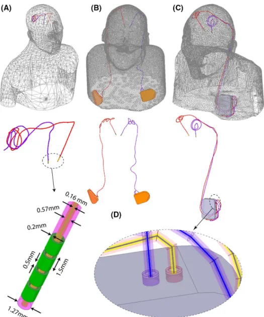FIGURE 2  Patient models developed for finite element simulations