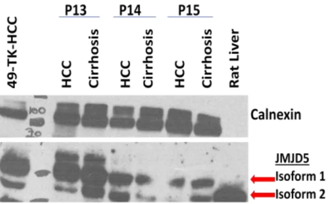 Figure  4.3: Screening for JMJD5 expression in HCC and cirrhosis  sample pairs of 15 patients  using western blotting technique  