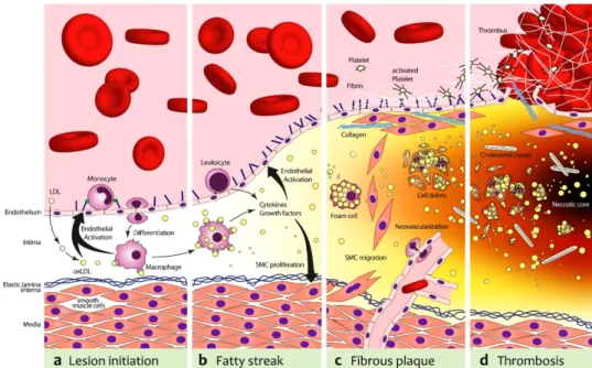 Figure 1.8. Four Stages of Atherosclerotic Lesion Formation (204) 