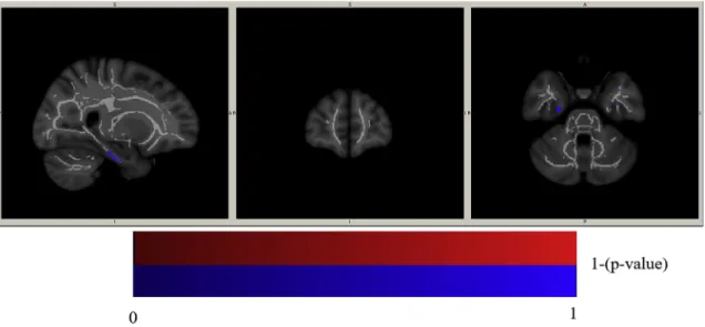 Fig. 3. Visual representation of the trend-level main e ﬀects of PRS on MD for a TFCE-uncorrected p-value < 0.01