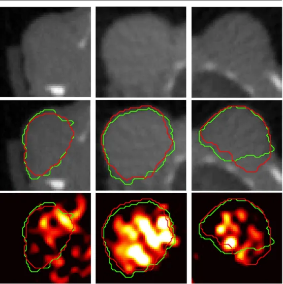 Figure 8. Comparison between segmentation results (red contour) against manual segmentations (green contour) and tumour PET tracer uptake for three different A549 subcutaneous tumours (one per column)