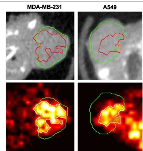 Figure 9. Comparison between the CT tumour segmentation result (green contour) and a region growing algorithm for segmenting the tumour PET signal (red contour in top CT image, white contour in bottom PET image)