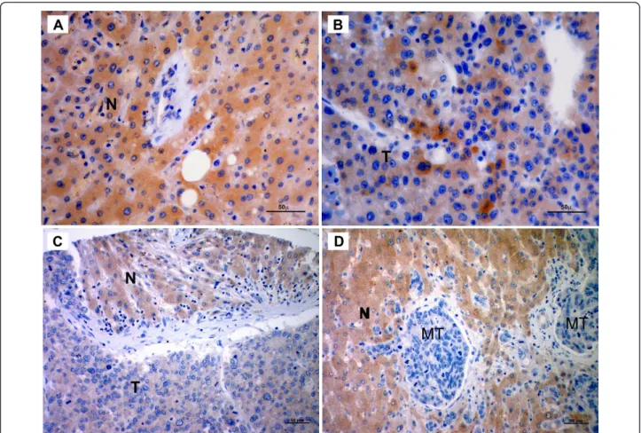 Figure 3 SIP1 protein expression in human liver tissues. Photographs are representative of SIP1 immunohistochemistry in human liver tissues