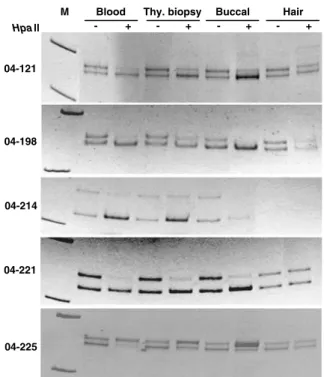Table 2 X-chromosome inactivation patterns in blood, thyroid, buccal mucosa, and hair follicle specimens Sample 04-121 04-198 04-214 04-221 04-225 Blood 94:6 91:9 84:16 92:8 91:9 Thyroid 72:28 79:21 76:24 74:26 64:36 Buccal 86:14 97:3 87:13 89:11 82:18 Hai