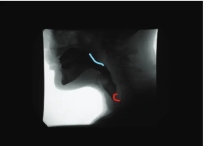 Figure 1. No contact of the tongue with the posterior pharyngeal wall (blue line)   and a cricopharyngeal bar (red line)