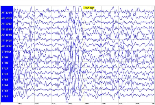Rysunek 2. Zapis badania EEG dziewczynki wykonanego po roku od pierwszego   napadu padaczki