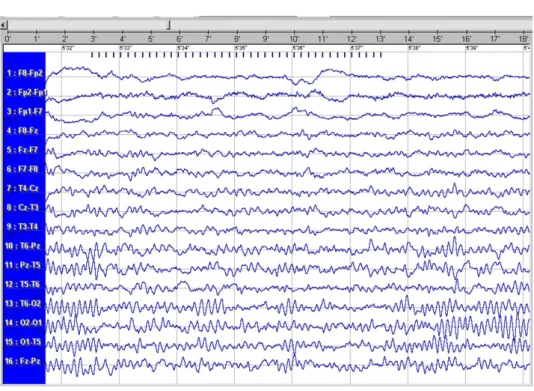 Rysunek 4. Zapis badania EEG dziewczynki wykonanego w piątym roku choroby