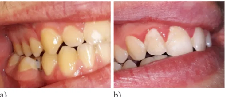Figure 1. Example of a unilateral posterior crossbite,  supragingival plaque and gingivitis (left and right panels,  respectively) observed in our group of swimmers