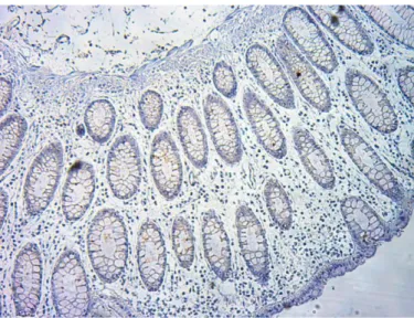 Fot.  2.  Białko  Hsp70  barwione  metodą  immunohistochemiczną.  Na  zdjęciu  pojedyncze  widoczne w polu widzenia wybarwione komórki nabłonkowe (ocena 1 w stosowanej skali)