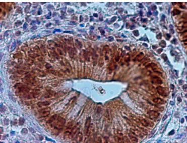 Fot.  4.  Białko  Hsc70  barwione  metodą  immunohistochemiczną.  Na  zdjęciu  pojedyncze  widoczne w polu widzenia wybarwione komórki nabłonkowe (ocena 1 w stosowanej skali)