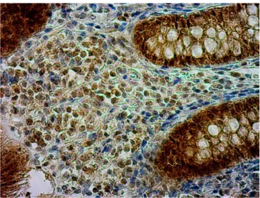 Fot.  6.  Białko  Hsc70  barwione  metodą  immunohistochemiczną.  Na  zdjęciu  pojedyncze  widoczne w polu widzenia wybarwione komórki nacieku zapalnego (ocena 1 w stosowanej  skali)