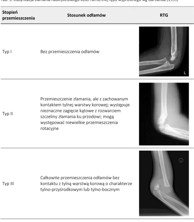 Tab. 3. Klasyfikacja złamania nadkłykciowego kości ramiennej typu wyprostnego wg Gartlanda (1959) 