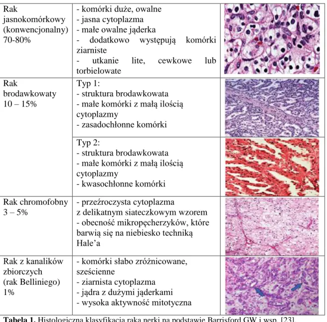 Tabela 1. Histologiczna klasyfikacja raka nerki na podstawie Barrisford GW i wsp. [23]