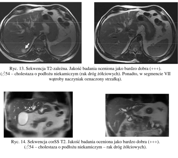 Tabela 8. Wyniki testu post-hoc dla jakości obrazu pomiędzy parami sekwencji badania MR                   z  zastosowaniem  szybkich  technik  obrazowania  u  chorych  z  cholestazą  o  podłożu 
