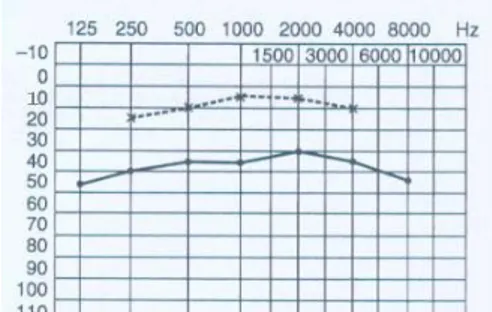 Figure 2: Pure-tone threshold audiometry – conductive hearing  loss x-----x bone, •——• air [2].