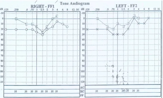 Figure 7: PTA of one of the soldiers – mild bilateral hearing loss, unusual for AAT.