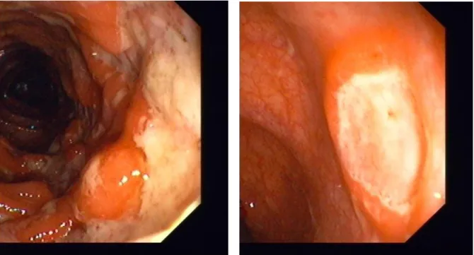 Fot.  2  Kontrolna  kolonoskopia  po  leczeniu  indukcyjnym  adalimumabem  –  widoczny  efekt  gojenia  się  błony  śluzowej z całkowitym zniknięciem owrzodzeń
