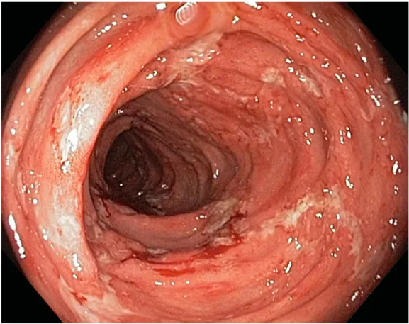 Fot.  4 Obraz  jelita  grubego  w  kontrolnej  kolonoskopii  po  leczeniu  indukcyjnym infliksymabem  –  widoczny  efekt  gojenia się błony śluzowej pod wpływem leczenia
