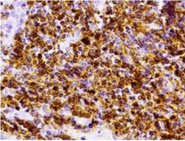 Fot.  9  Immunocytochemiczna  lokalizacja  cząsteczki  CD4  w  bioptacie  jelita  grubego  pobranym  z  miejsca  zmienionego zapalnie przed leczeniem
