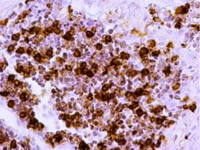 Fot.  13  Immunocytochemiczna  lokalizacja  cząsteczki  CD8  w  bioptacie  jelita  grubego  pobranym  z  miejsca  zmienionego zapalnie przed leczeniem