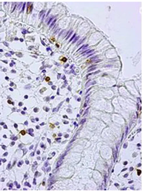 Fot.  15  Immunocytochemiczna  lokalizacja  cząsteczki  CD8  w  bioptacie  jelita  grubego  pobranym  z  miejsca  niezmienionego zapalnie przed leczeniem