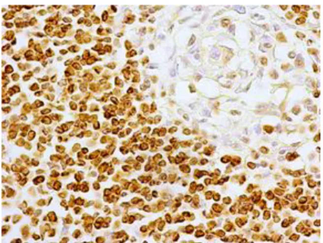 Fot.  23  Immunocytochemiczna  lokalizacja  białka  Bcl-2  w  bioptacie  jelita  grubego  pobranym  z  miejsca  zmienionego zapalnie przed leczeniem