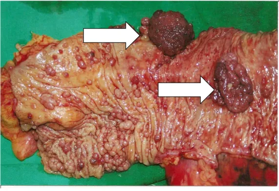 Fig.  6  Polipowatość  jelita  grubego  (FAP)  –  jelito  grube  z  licznymi  polipami,  dwa  z  nich  z  transformacją złośliwą (strzałki)