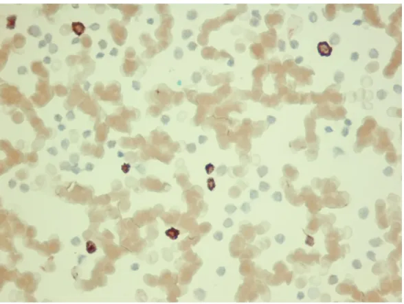 Fot. 2. Immunocytochemiczna ekspresja antygenu CD105 u pacjenta z ALL przed rozpoczęciem leczenia  (niekorzystny  przebieg  choroby)