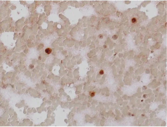 Fot. 4. Reakcja immunocytchemiczna wykrywająca obecność antygenu CD105. Ekspresja obserwowana  we  wszystkich  limfoblastach