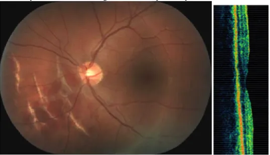 Fig. 8. Peri-papillar  indirect choroidal ruptures and macular OCT three weeks after the trauma during  paintball game, BCVA 1,0