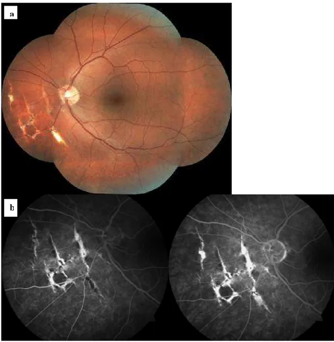 Fig. 10. Eye fundus (a) and fluorescein angiography (b) of choroidal ruptures area  one year after the  trauma during paintball game