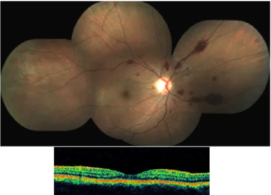 Fig.  12.  Regression  of  retinal  abnormalities:  eye  fundus  three  weeks  after  a  champagne  pop  injury,  BCVA 1,0