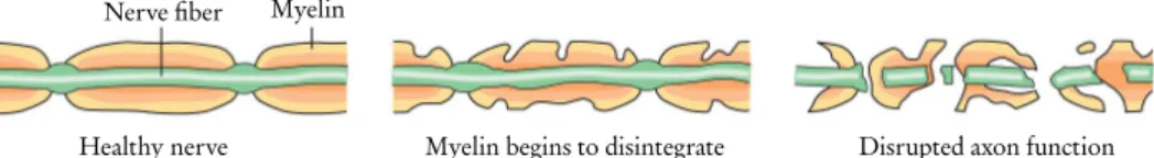 Figure 3.4 Illustration of the progress of demyelination in the MS disease. Damage to the myelin sheath reveals the nerve ﬁber and weakens nerve signal transduction