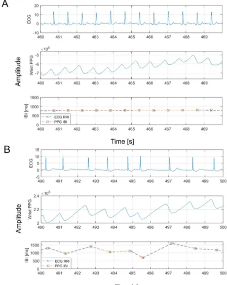 Figure 3 describes an example of the waves used for IBI detection in both SR and AF.