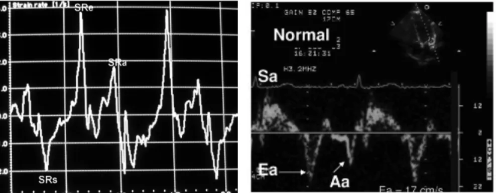 Figure 3. Examples of a) strain rate and b) tissue velocity TDI measurements  [44] .  The function of the heart can be assessed by TDI in a variety of ways, such as by  analyzing the strain rate and estimating the filling pressure of the LV [45, 44]