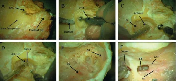 Figure 6. Mastoidectomy and posterior tympanotomy procedure  performed to a cadaver temporal bone