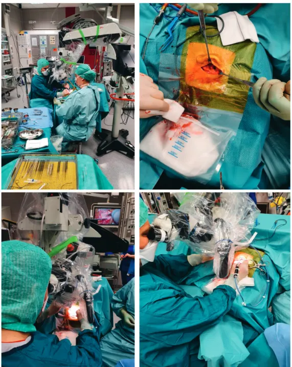 Figure 7. Temporal bone surgery and operating room setup during a  cochlear implantation procedure