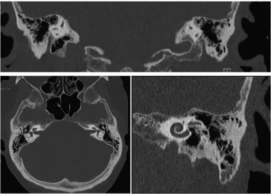 FIGURE 8. Clinical high resolution computed tomography (HRCT) images of  temporal bone