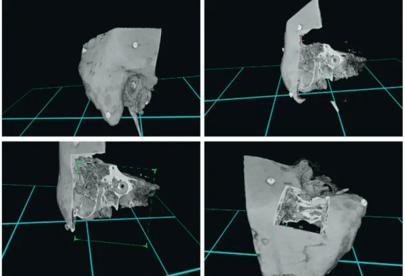 Figure 10. Temporal bone in virtual reality (With courtesy of Adesante Oy,  Turku, Finland) 