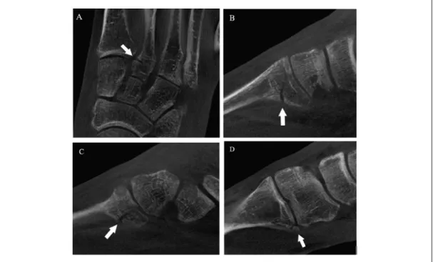 Figure 1.  (A-D) Computed tomographic findings of Lisfranc injury.