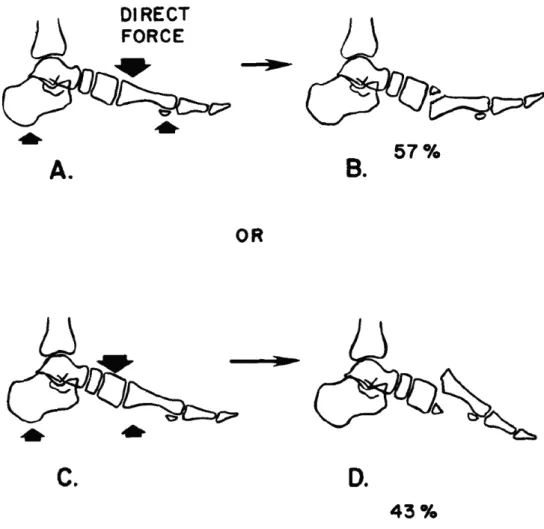 Figure 3.  Direct injury mechanism by Myerson et. al (1986). (copyright SAGE publications
